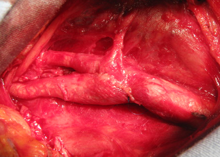 Carotid bifurcation after eversion CEA