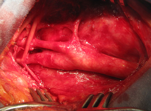 Carotid bifurcation